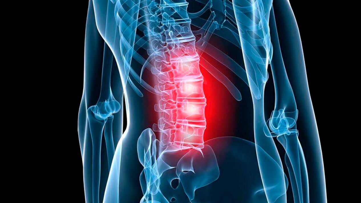 simptome de osteocondroză lombară