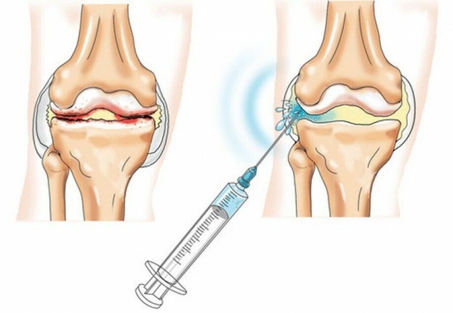 injectare în articulația genunchiului cu artroză
